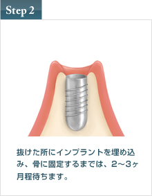 インプラント治療 step2