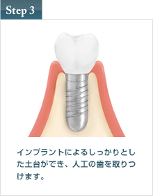 インプラント治療 step3