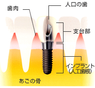 インプラント構造