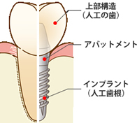 インプラント構造