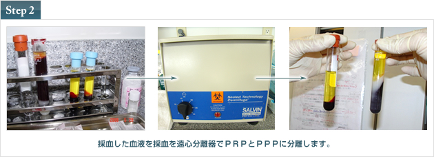 採血した血液を採血を遠心分離器でＰＲＰとＰＰＰに分離します。