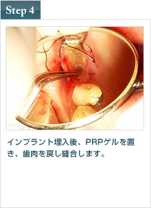 インプラント埋入後　PRPゲルを置き、歯肉を戻し縫合します。